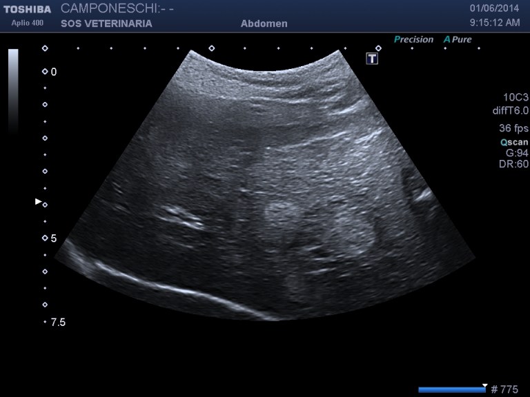 fegato lesioni focali e parenchima lievemente disomogeneo