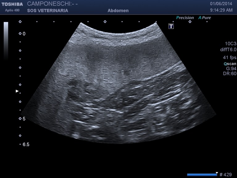 milza lesione focale