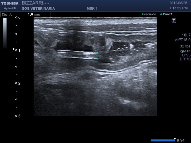 scansione longitudinale ascaride all'interno del lume diametro inferiore ai 2mm,non si evidenzia cono d'ombra