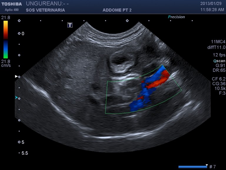 dilatazione del coledoco che decorre rettilineo