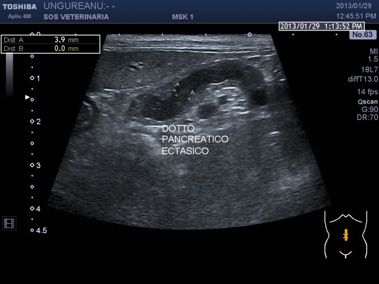 dotto pancreatico ectasico