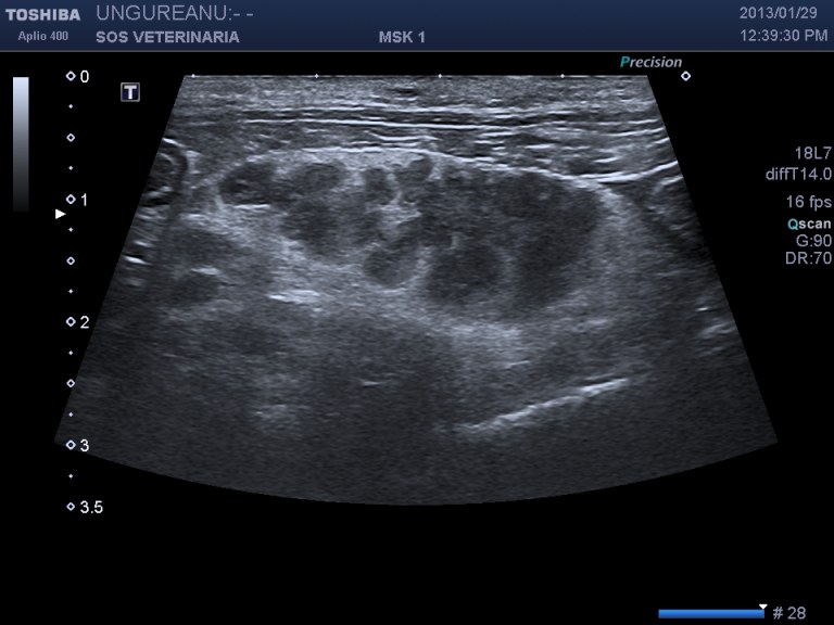 masse infiltranti peritoneali diffuse -linfonodali compatibili