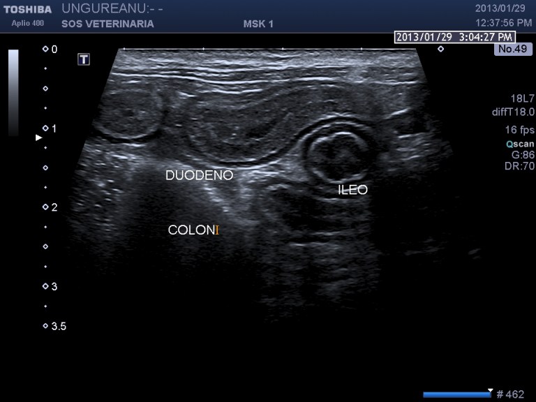 mucosa duodenale incremento ecogenicita'