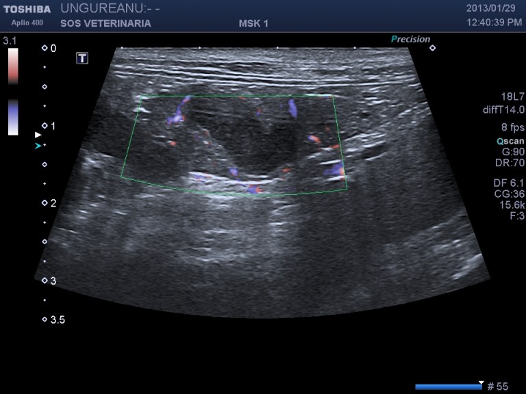 pancreas e dotto ectasico principale