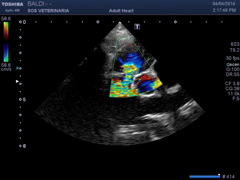 particolare stenosi in parasternale dx asse corto