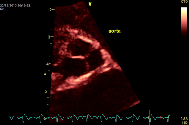 aorta