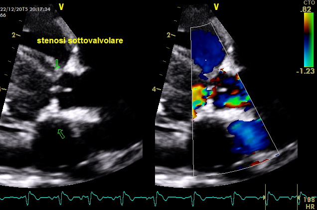 particolare stenosi subvalvolare