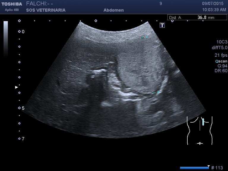 lesione focale demarcata iperecogena generalmente omogenea 
